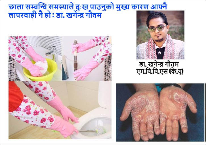छाला सम्बन्धि समस्याले दुःख पाउनुको मुख्य कारण आफ्नै लापरवाही नै हो : डा. खगेन्द्र गौतम